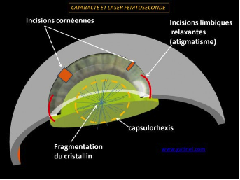 femtocataracte2
